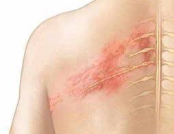 Cảnh báo: Virus thủy đậu tiềm ẩn gây bệnh Zona ở người trên 50 tuổi