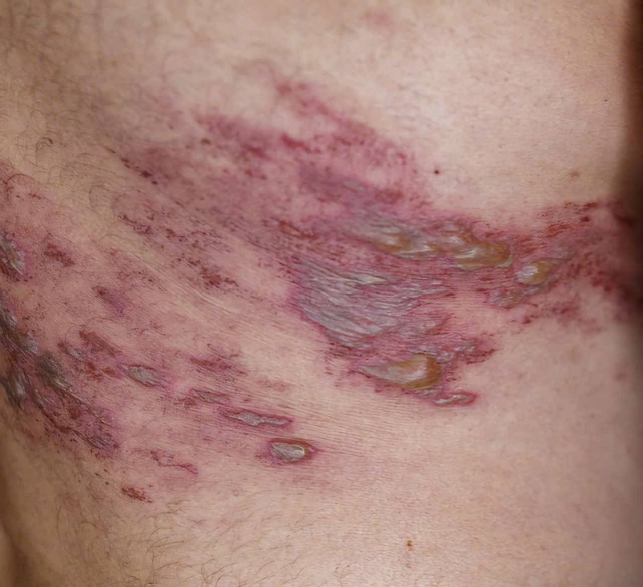 Cảnh báo: Virus thủy đậu tiềm ẩn gây bệnh Zona ở người trên 50 tuổi