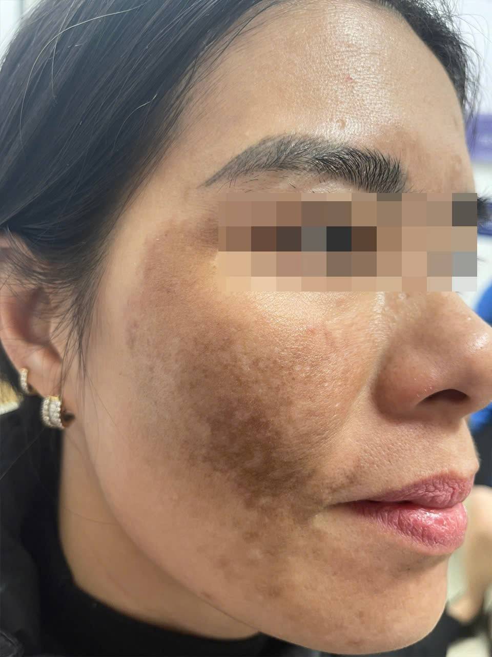 Chị N.T.N. (35 tuổi, quê Nam Định) đến khám trong tình trạng bỏng, thâm sạm toàn bộ khuôn mặt