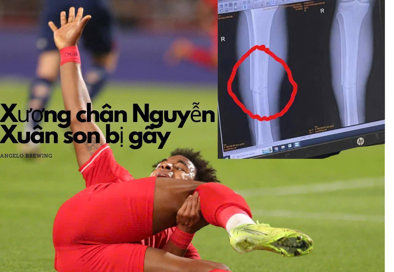 Chăm sóc và điều trị gãy xương chân của Nguyễn Xuân Son: Góc nhìn từ chuyên gia