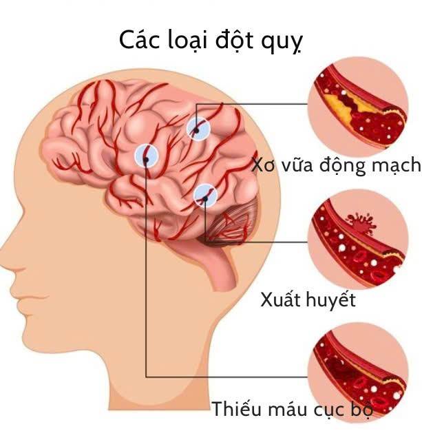 Mỡ máu cao: hiểm họa tiềm ẩn dẫn đến đột quỵ và cách phòng ngừa hiệu quả Mỡ máu cao: hiểm họa tiềm ẩn dẫn đến đột quỵ và cách phòng ngừa hiệu quả