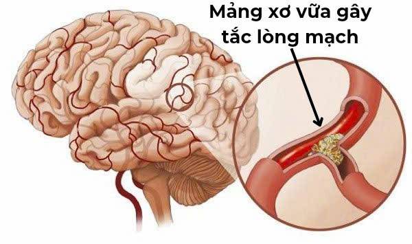 Mỡ máu cao: hiểm họa tiềm ẩn dẫn đến đột quỵ và cách phòng ngừa hiệu quả Mỡ máu cao: hiểm họa tiềm ẩn dẫn đến đột quỵ và cách phòng ngừa hiệu quả
