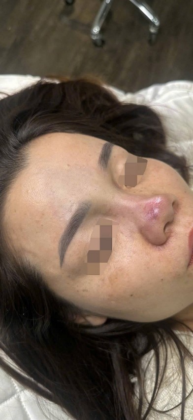 Liên tiếp các ca biến chứng do làm đẹp cấp tốc đón Tết