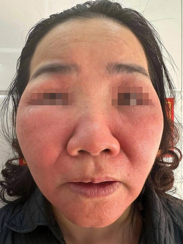 Liên tiếp các ca biến chứng do làm đẹp cấp tốc đón Tết