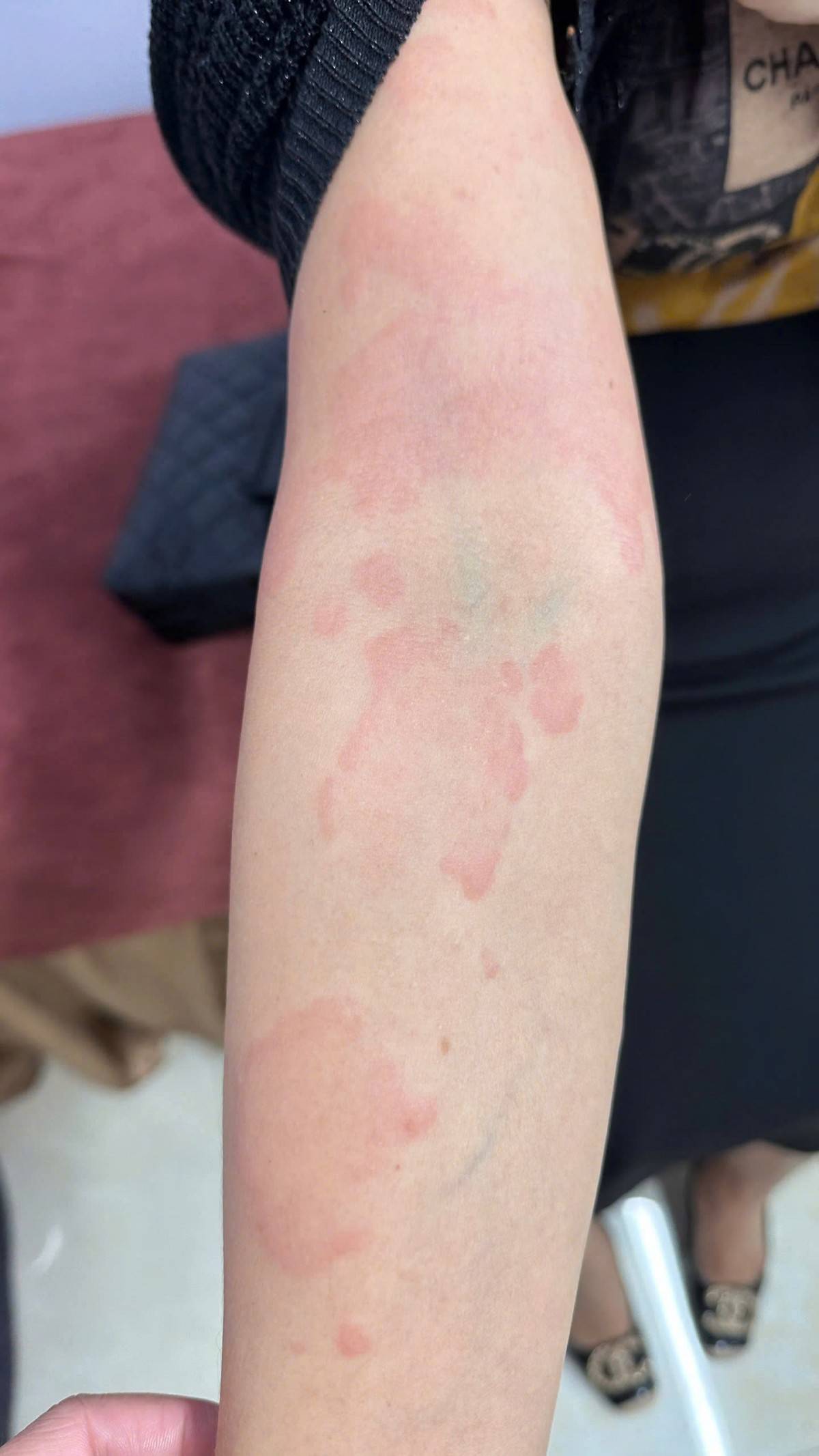 Mày đay có thương tổn da là những sẩn phù được bao quanh bởi quầng đỏ, rất ngứa.  Mày đay có thương tổn da là những sẩn phù được bao quanh bởi quầng đỏ, rất ngứa.