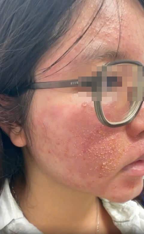 Bệnh nhân bị nổi mẩn khắp người sau khi dùng mỹ phẩm Bệnh nhân bị nổi mẩn khắp người sau khi dùng mỹ phẩm