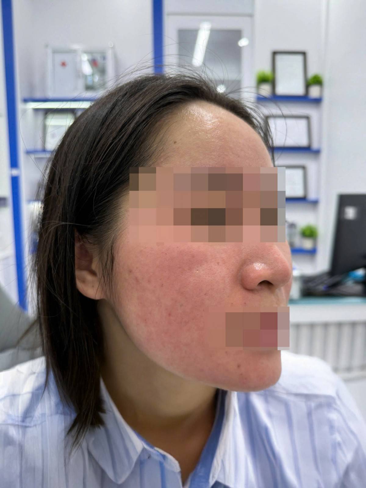 Các vùng da bong tróc, sưng tấy sau chữa mụn bằng nước chanh. (Ảnh: BSCC)