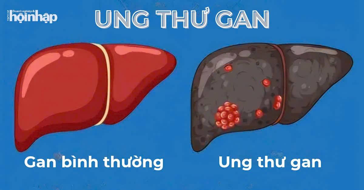 Ung thư gan: Những dấu hiệu ban đầu bạn nên biết để phòng ngừa kịp thời