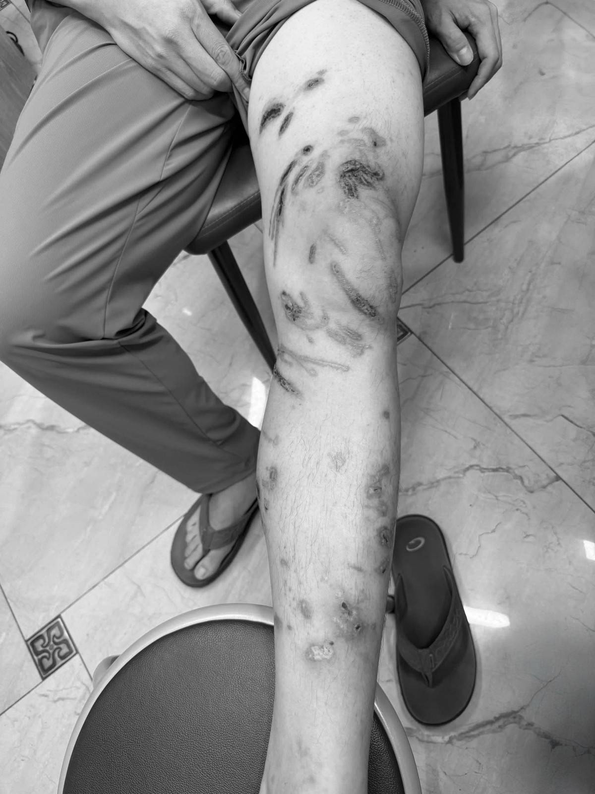 sẽ mất vài tháng để da phục hồi hoàn toàn phần sẹo do sứa gây ra.