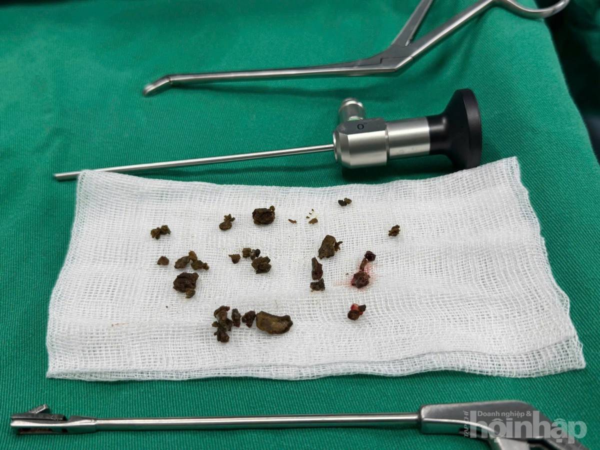 Trung tâm Y tế huyện Hạ Hòa: Phẫu thuật nội soi xoang hàm thành công