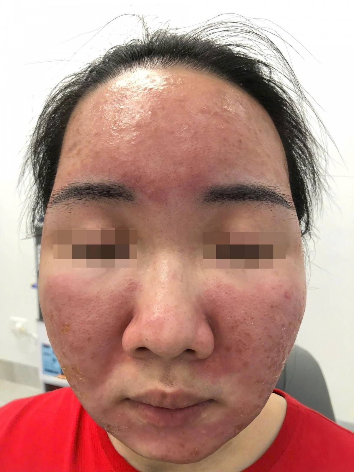 sinh viên một trường đại học tại Hà Nội đã phải đi khám bác sĩ da liễu vì vùng mặt bỏng rát, bong tróc và thâm sạ sinh viên một trường đại học tại Hà Nội đã phải đi khám bác sĩ da liễu vì vùng mặt bỏng rát, bong tróc và thâm sạ