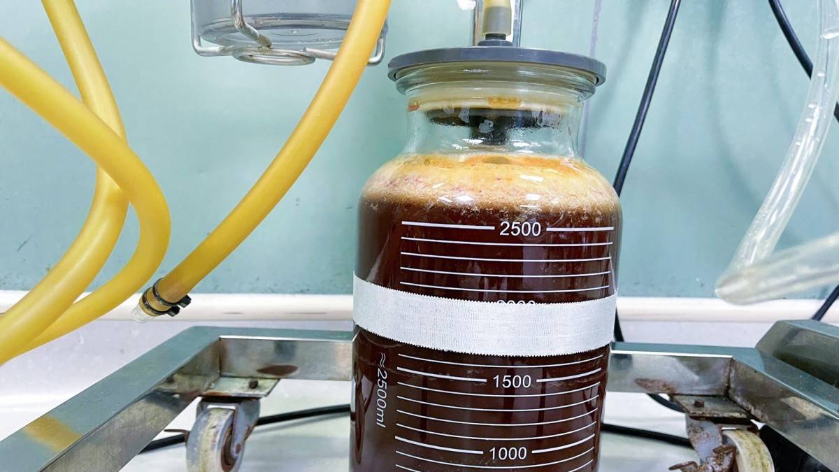 Bác sĩ buộc phải nạo hút đến 3.000ml mủ và filler do mô hoại tử lan sâu, áp xe toàn vùng cơ cho một bệnh nhân tiêm filler không rõ nguồn gốc.