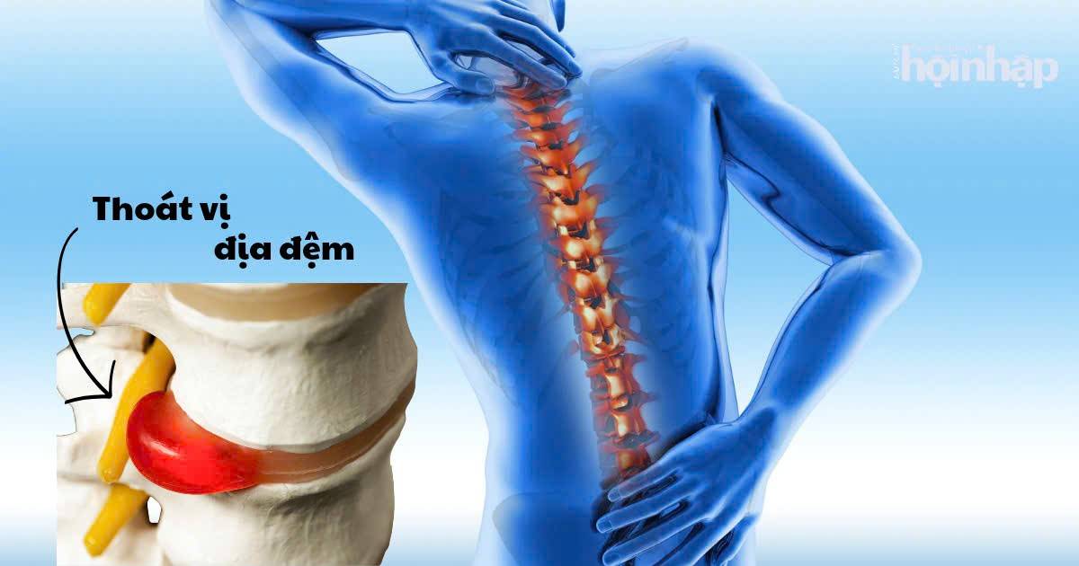 25 tuổi đã thoái hóa cột sống: Sự thật cảnh báo giới trẻ