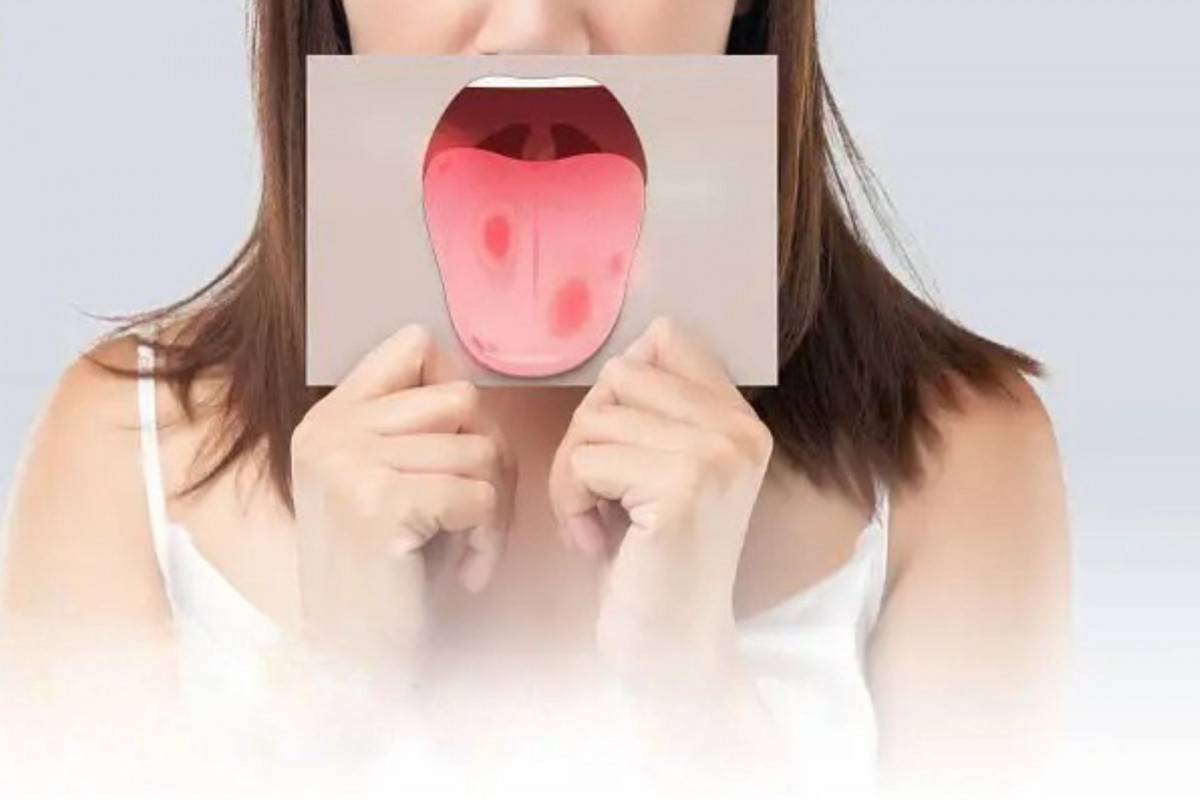 Cô gái trẻ nhầm tưởng bị nhiệt miệng, ai ngờ mắc sùi mào gà ở miệng