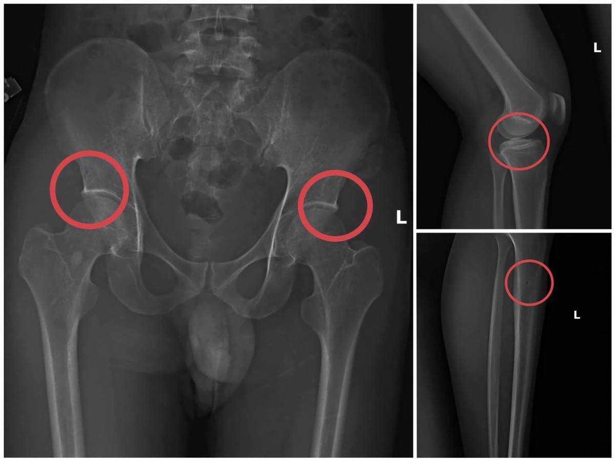 Phú Thọ: Tự gây gãy xương chiếm đoạt hơn 6 tỷ đồng bảo hiểm nhân thọ