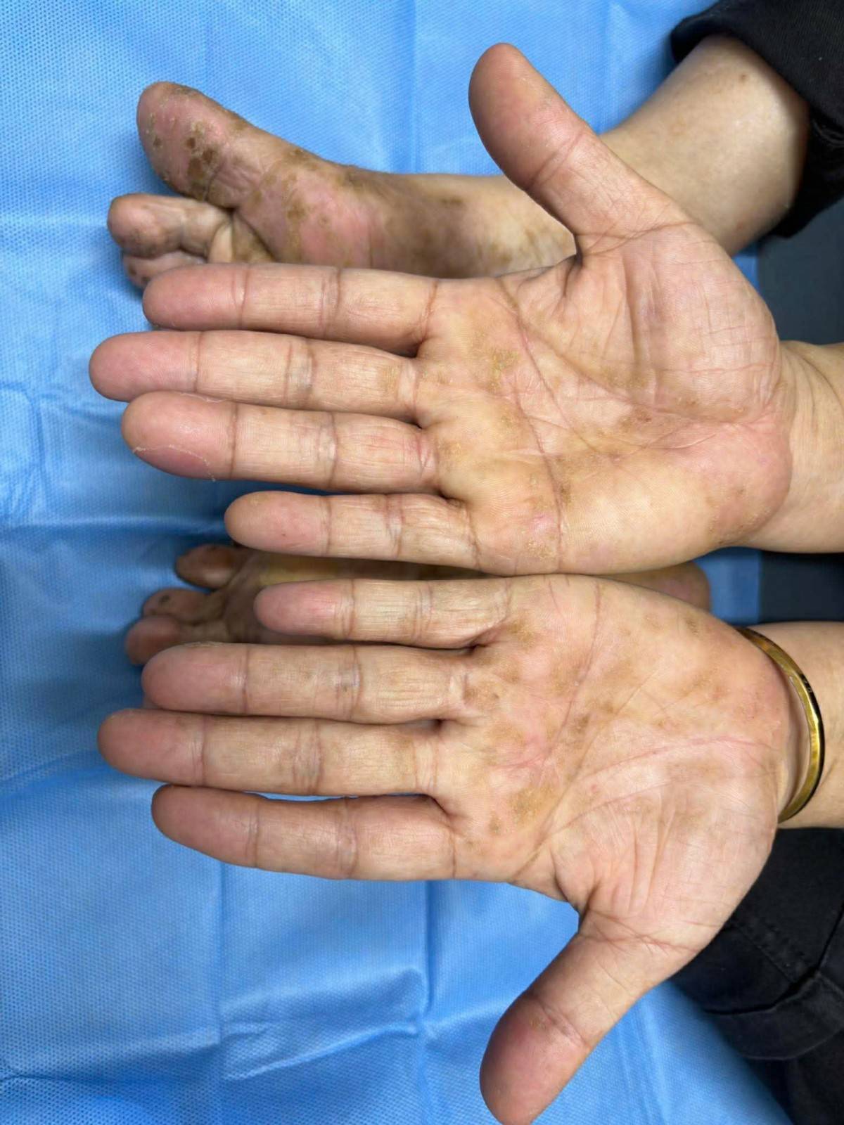 Viêm da cơ địa mùa đông: Cảnh báo nguy cơ tái phát nặng và hướng dẫn kiểm soát từ chuyên gia da liễu