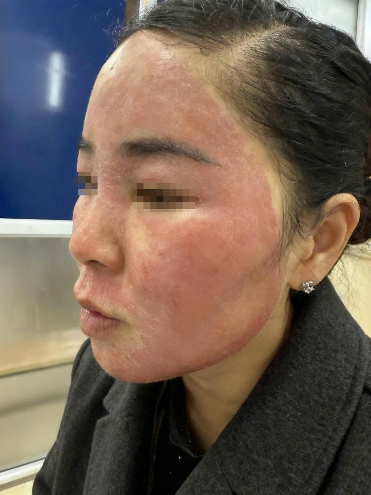 Được mời “làm đẹp cấp tốc” đón Tết, thiếu nữ hỏng khuôn mặt