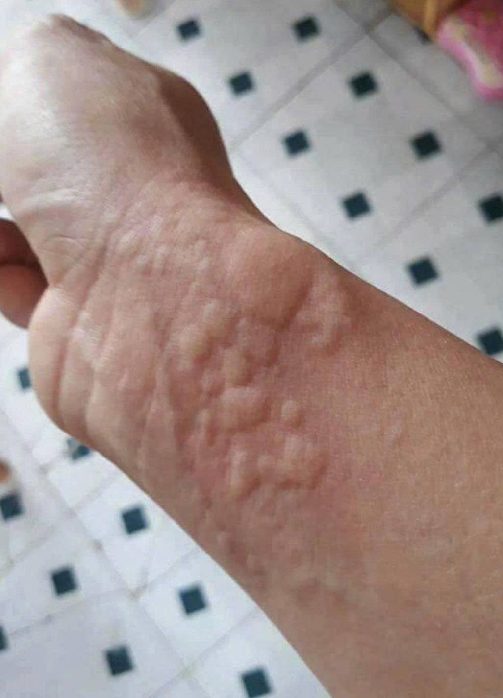 các sẩn phù nổi trên da, bao quanh bởi quầng đỏ, gây ngứa dữ dội