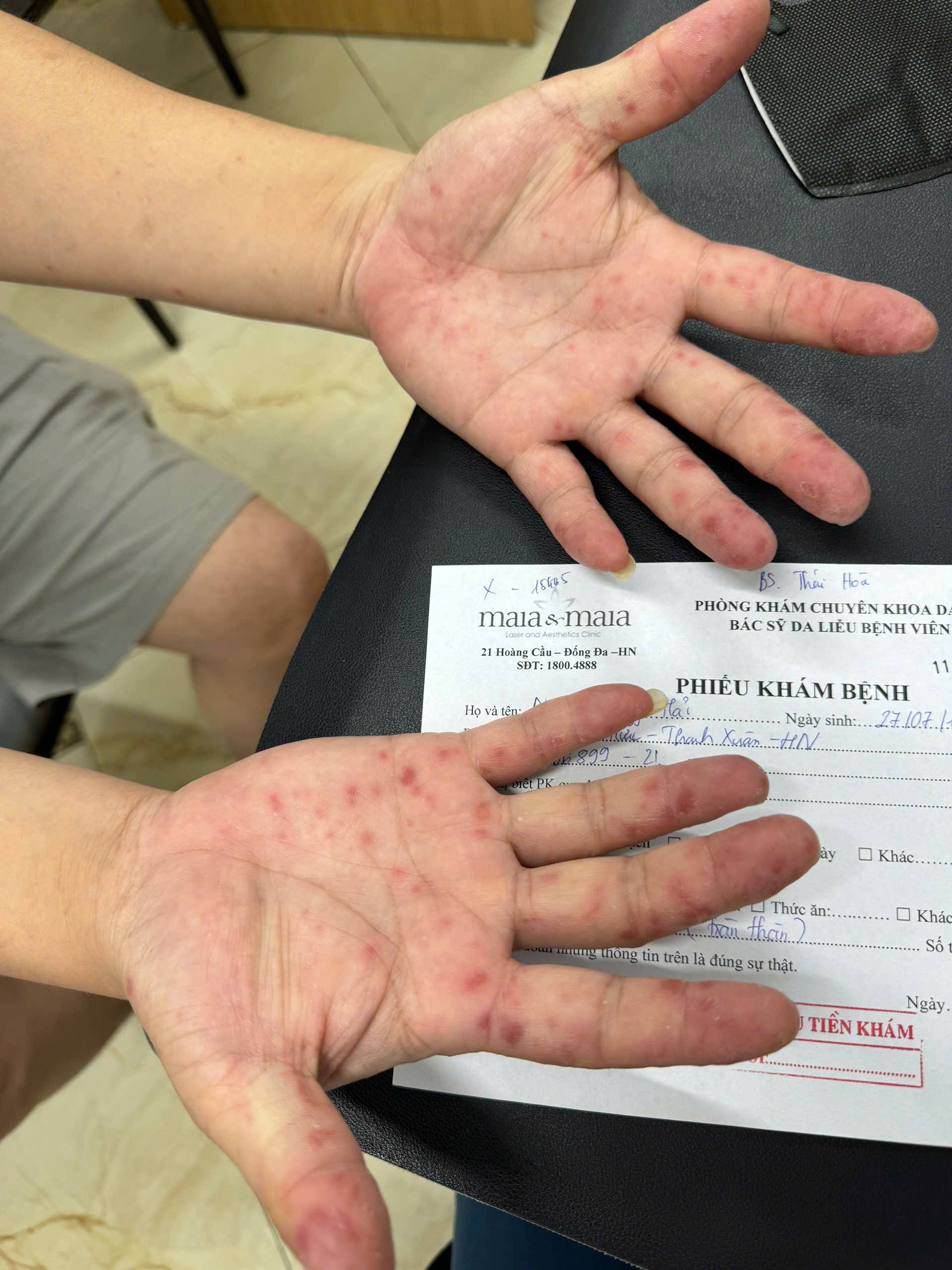 Tay chân miệng tăng nóng: Bác sĩ chỉ nguồn lây từ thứ hay bị bỏ quên