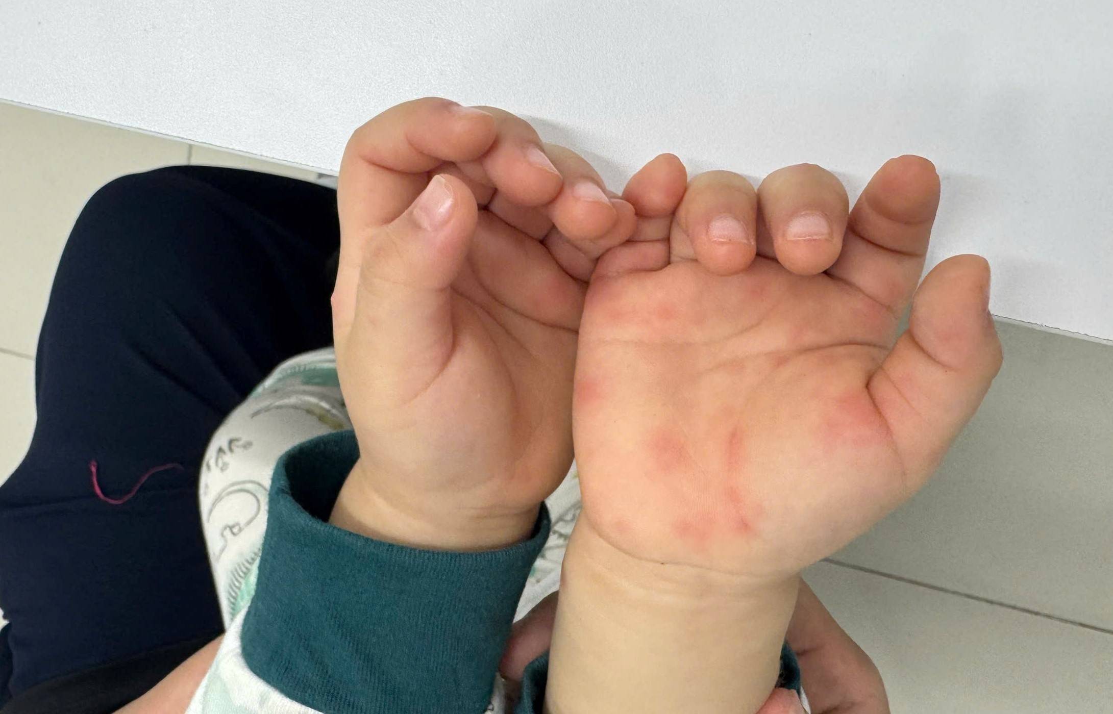 Tay chân miệng tăng nóng: Bác sĩ chỉ nguồn lây từ thứ hay bị bỏ quên