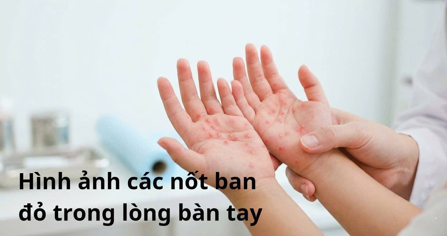Lần đầu tiên Việt Nam có vaccine bệnh tay chân miệng: Hiệu quả 96,8% và điều cha mẹ cần biết ngay