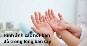 Lần đầu tiên Việt Nam có vaccine bệnh tay chân miệng: Hiệu quả 96,8% và điều cha mẹ cần biết ngay