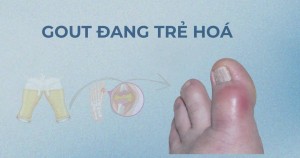 Vì sao gout ở nam giới trung niên ngày càng phổ biến và trẻ hóa?