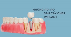 Những rủi ro sau cấy ghép implant mà người bận rộn nên biết