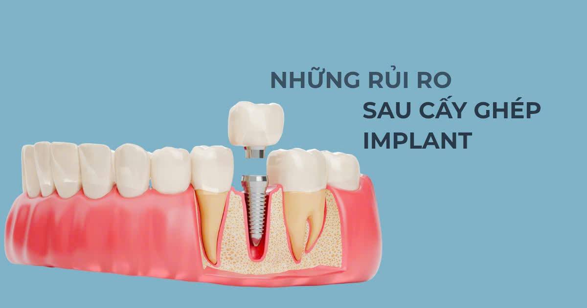 Những rủi ro sau cấy ghép implant mà người bận rộn nên biết
