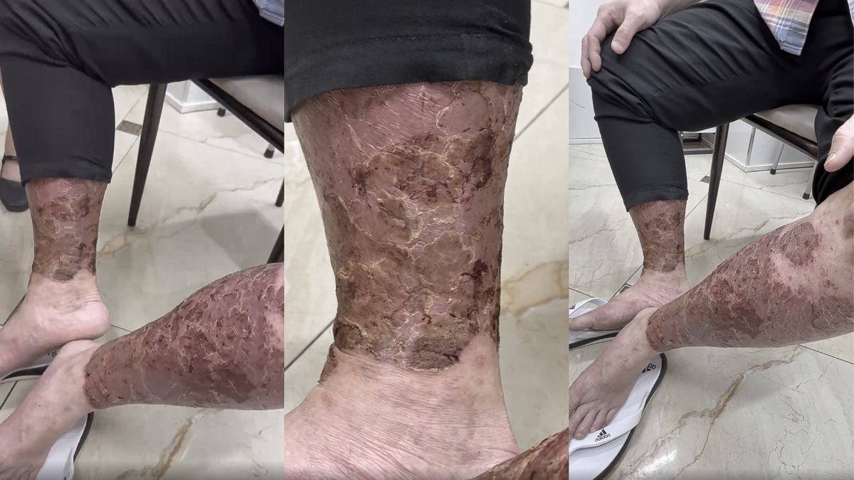 Ngứa kéo dài, nam thanh niên lạm dụng rượu để ngủ, men gan tăng cao