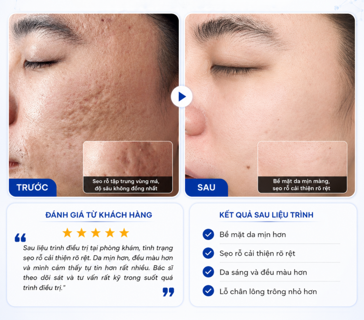 Feedback của khách hàng điều trị sẹo rỗ tại Phòng khám Da liễu LG Clinic