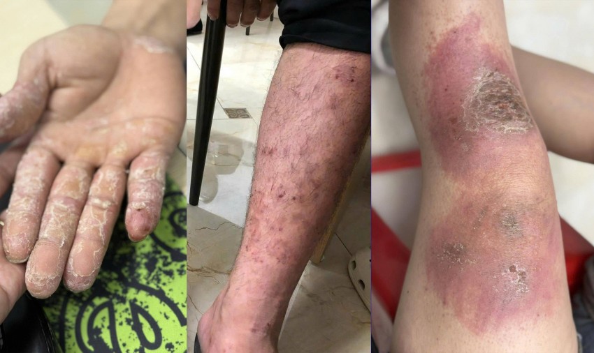 Lội nước ngập nhiều giờ ở Hà Nội, dấu hiệu trên da nào cần cảnh giác?