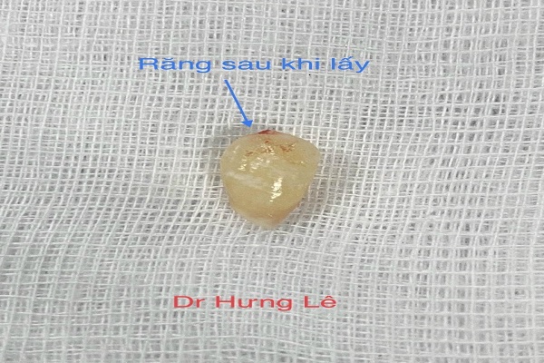 Chiếc răng mọc lạc trong hốc mũi của bệnh nh&amp;acirc;n Minh
