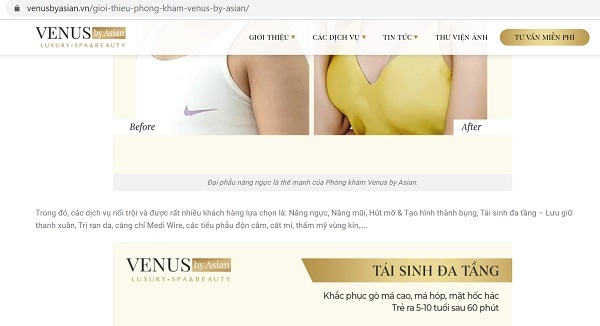 Venus By Asian ngang nhi&amp;ecirc;n giới thiệu về dịch vụ phẫu thuật thẩm mỹ tr&amp;ecirc;n website https://venusbyasian.vn: &amp;ldquo;Hiện tại Venus by Asian đang cung cấp đến kh&amp;aacute;ch h&amp;agrave;ng gần 100 dịch vụ từ cơ bản đến cao cấp, đ&amp;aacute;p ứng mọi nhu cầu l&amp;agrave;m đẹp của kh&amp;aacute;ch h&amp;agrave;ng... Trong đ&amp;oacute;, c&amp;aacute;c dịch vụ nổi trội v&amp;agrave; được rất nhiều kh&amp;aacute;ch h&amp;agrave;ng lựa chọn l&amp;agrave;: N&amp;acirc;ng ngực, N&amp;acirc;ng mũi, H&amp;uacute;t mỡ...